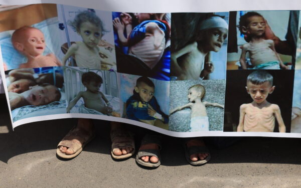 epa12256137 Protesters hold a banner showing Palestinian children suffering from severe malnutrition, during a rally calling for an end to the war on Gaza, at Sana'a University, in Sana'a, Yemen, 23 July 2025. Students and professors rallied at Sana'a University in solidarity with the Palestinian people, demanding an end to the war on the Gaza Strip and the resulting famine.  EPA/YAHYA ARHAB